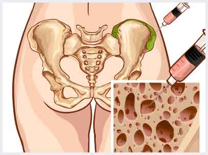 Bone Marrow Stem Cell Treatment