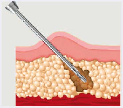 Fat Aspirate Stem Cell Treatment