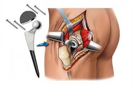 Hip placement surgery