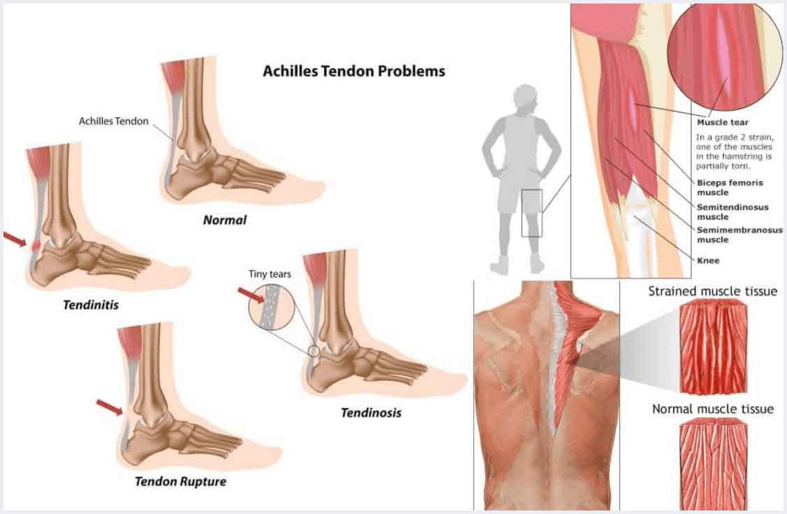 tendon muscle pain stem cell treatment