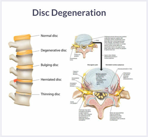 intervertebral disc degeneration