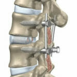 spinal fusion surgery