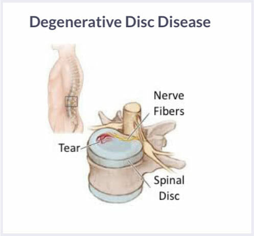 degenerative disc disease