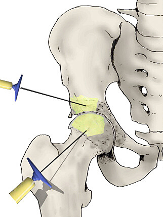 hip interosseous